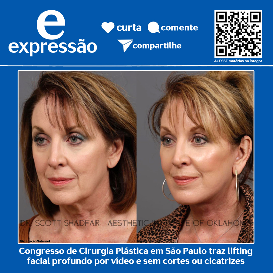 Leia mais sobre o artigo Congresso de Cirurgia Plástica em São Paulo traz lifting facial profundo por vídeo e sem cortes ou cicatrizes